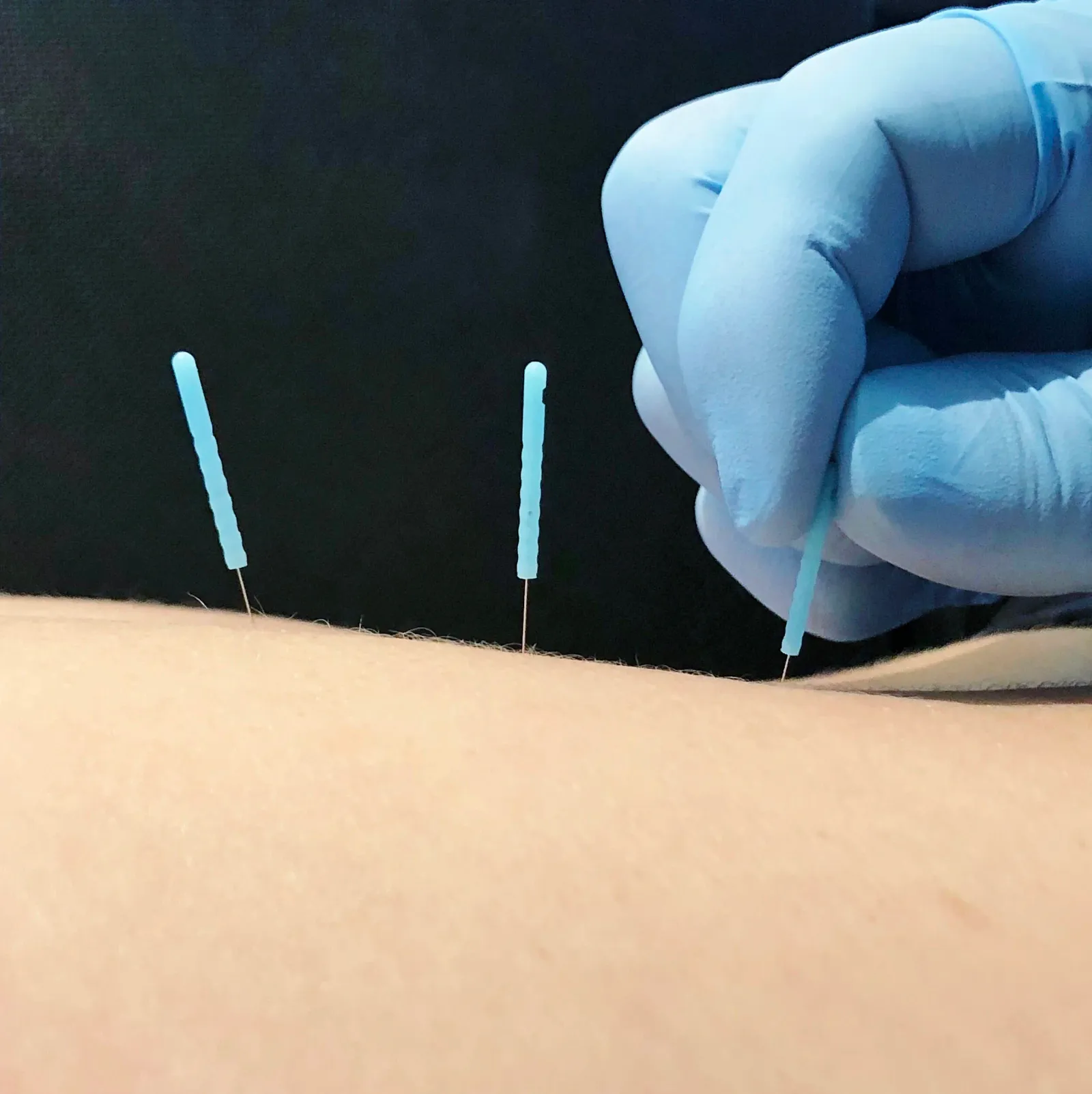 Acupuncture – Could it help your pain?